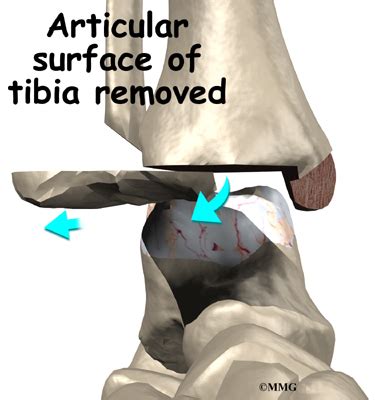 Ankle Fusion | eOrthopod.com