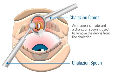 Chalazion Removal Bristol Worcester Birmingham Rugby UK