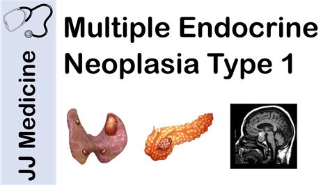 Multiple Endocrine Neoplasia Type 1 (MEN-1) | Signs and Symptoms, Diagnosis and Treatment - YouTube