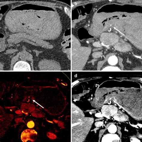 Endoscopic view showing the lesion in the prepyloric region | Download ...