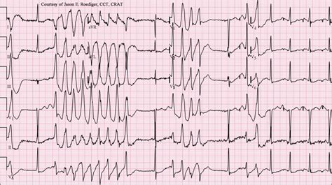 ECG (EKG) examples and quiz - Oxford Medical Education