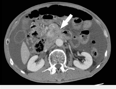 Figure 2 from The Malignant Obstruction Caused by Pancreatic Cancer Within the Uncinate Process ...