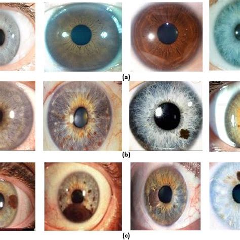 Iris melanocytic tumors (a) Iris nevus (pigmented), (b) Iris nevus ...