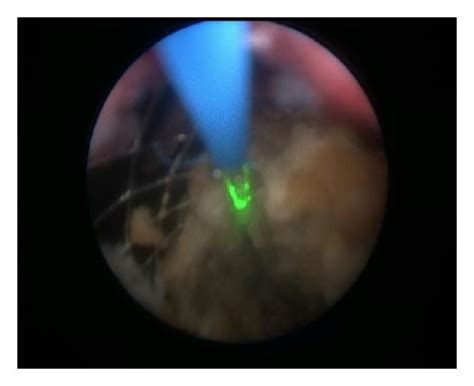 Image from the semirigid ureterorenoscopy with laser lithotripsy procedure. | Download ...