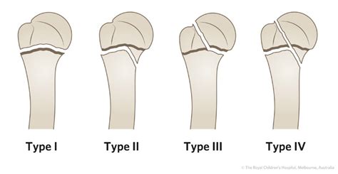 Clinical Practice Guidelines : Proximal humeral fractures - Emergency ...