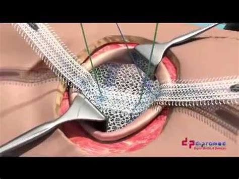 Ucmc clearmesh composite umbilical hernia repair – Artofit