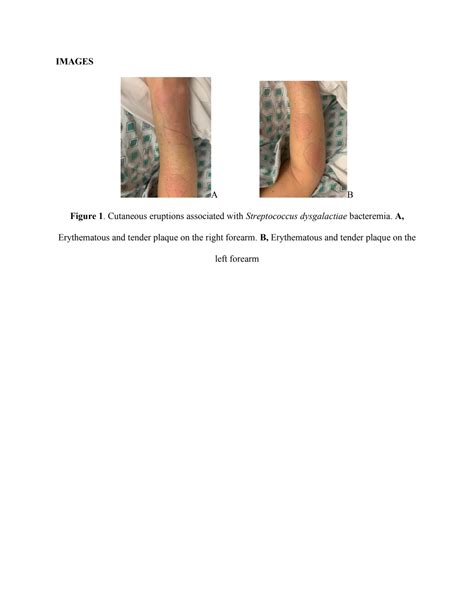 Streptococcus Dysgalactiae (Group C Streptococcus) Cutaneous Manifestations: A Case Report ...