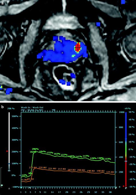 Imaging and MR Spectroscopy in Prostate Cancer | Radiology Key