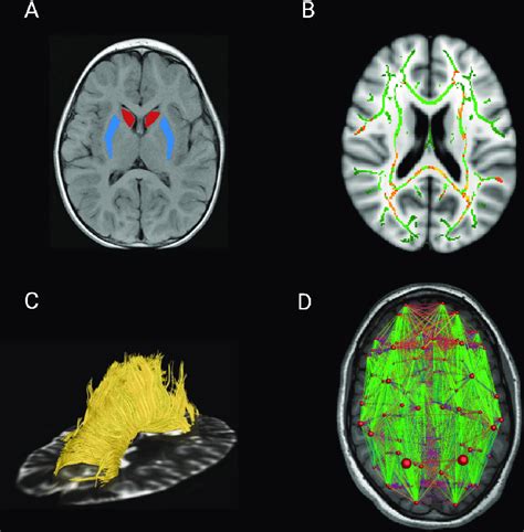 Diffusion imaging analysis techniques. (A) ROI analysis delineating the ...