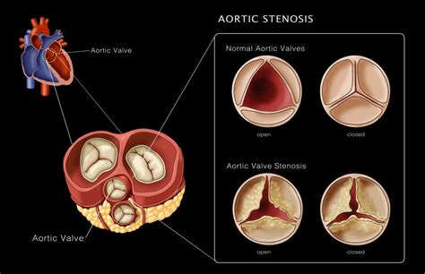 Anatomy Of The Aortic Valve | My XXX Hot Girl