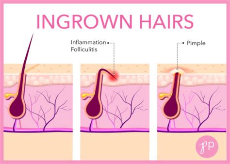 How To Treat & Prevent Ingrown Hairs - The Pretty Pimple