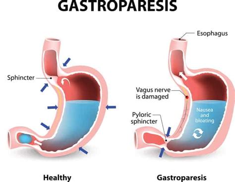 The Best Diet for Gastroparesis (Delayed Gastric Emptying) | Diet vs Disease | Gastroparesis ...