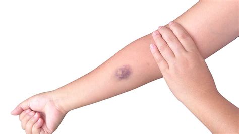 Ecchymosis Vs Bruise