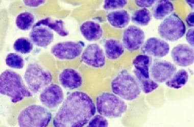 Acute Lymphoblastic Leukemia (ALL): Practice Essentials ...