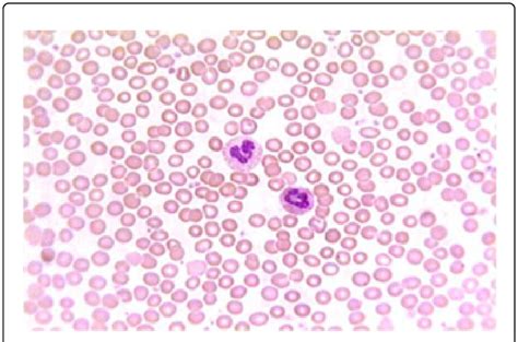 Normal Peripheral Blood Smear, 47% OFF