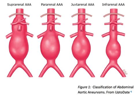 Abdominal Aortic Aneurysm (AAA) - St. George’s Aortic Team