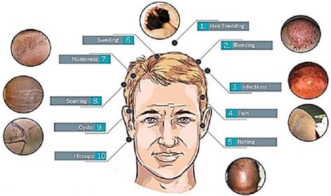 9 Possible Side Effects of Hair Transplant Surgery - Blog Medicine