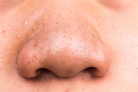 Here's How to Cover Every Type of Pimple | Allure