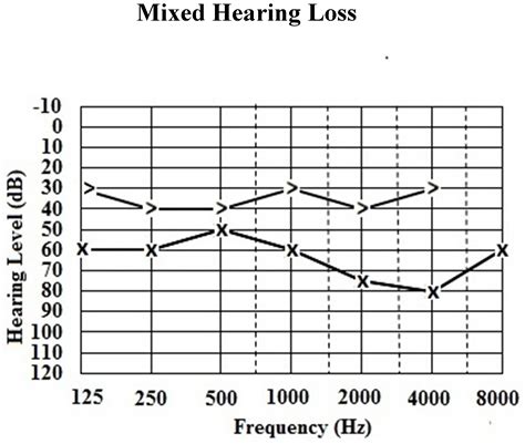 Classification of Hearing Loss | IntechOpen