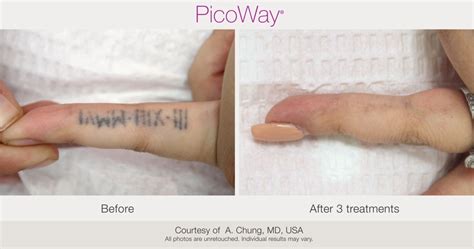 PicoWay Laser Tattoo Removal – Synergy Medical Aesthetics – Nanaimo, Victoria, Vancouver Island