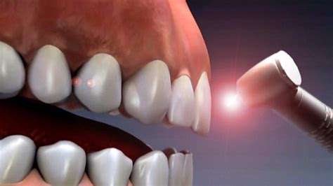 New Infrared Laser Technique Allows Teeth To Regrow And Repa