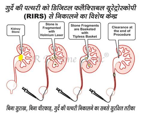 Treatment For Kidney Stone In Panipat Karnal Sonipat, Stone Treatment