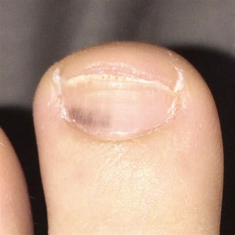 Is this melanoma under toenail? : r/Melanoma