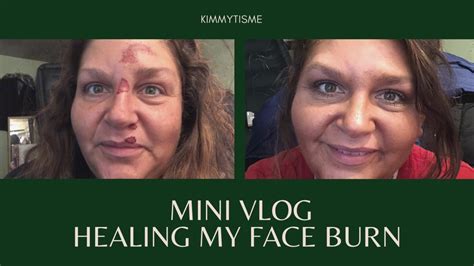 Mini Vlog Healing My Face Rug Burn On You