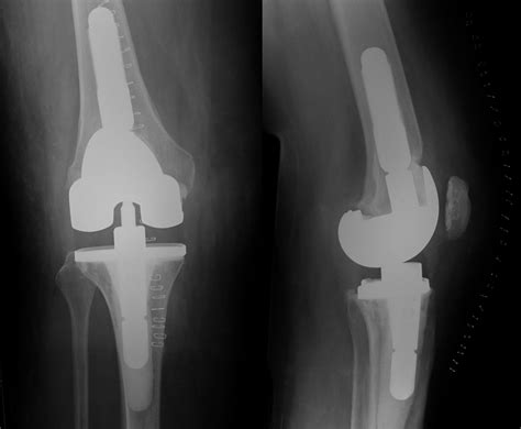 Knee Replacement – Sussex Knee Surgery