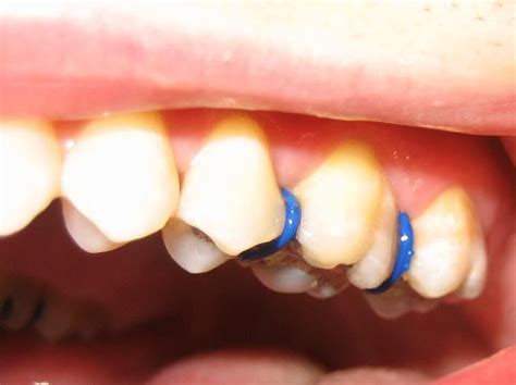 Spacers For Teeth - Get Images