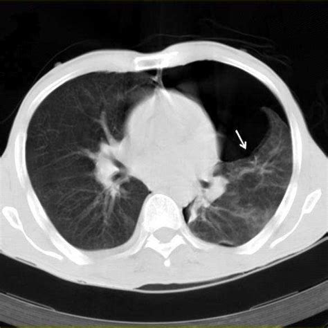 Chest CT scan uncovered a tension pneumothorax | Download Scientific Diagram