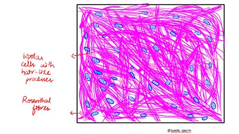 Pathology of Astrocytoma - Pathology Made Simple