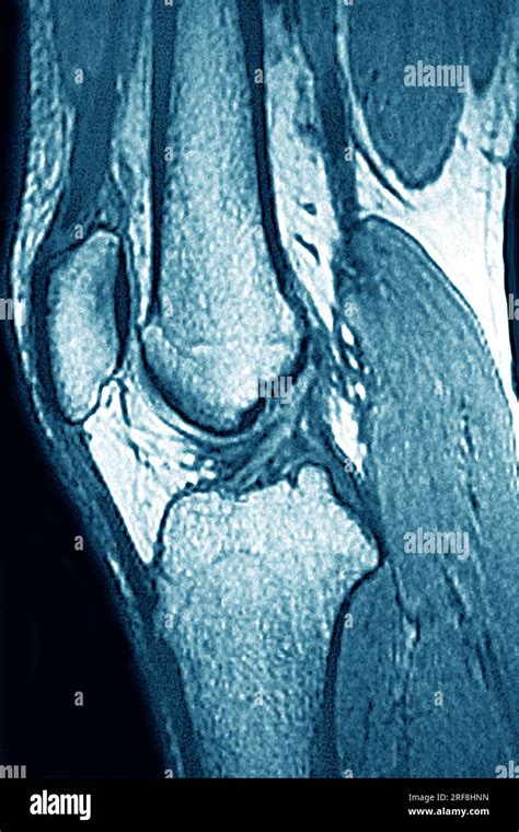 Normal knee visualized by MRI in sagittal section Stock Photo - Alamy