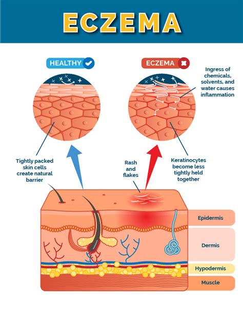 Eczema Treatments in Fresno | Valley Skin Institute