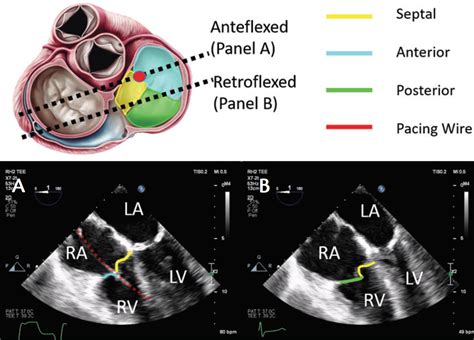 Imaging Considerations for Percutaneous Tricuspid Intervention ...