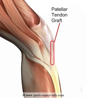 Learn About ACL Reconstruction - Patellar Tendon Graft