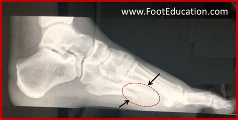 5th Metatarsal Shaft "Dancer's" Fracture | Localizador