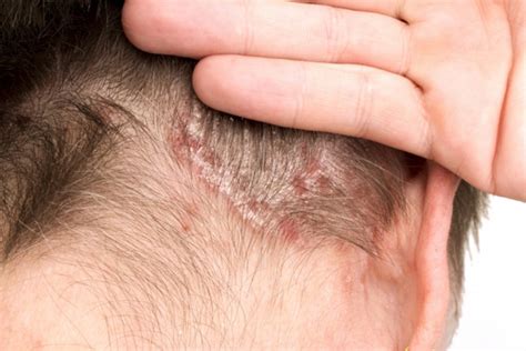 Pictures of Psoriasis (Page 5) | Psoriasis expert