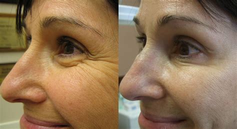 Botox for Crow's Feet Before and After