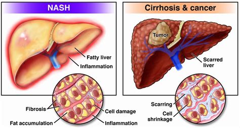 Nonalcoholic fatty liver disease (NAFLD) and nonalcoholic ...