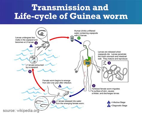 Dracunculiasis | Guinea-worm Disease - Symptoms, Diagnosis, Treatment ...