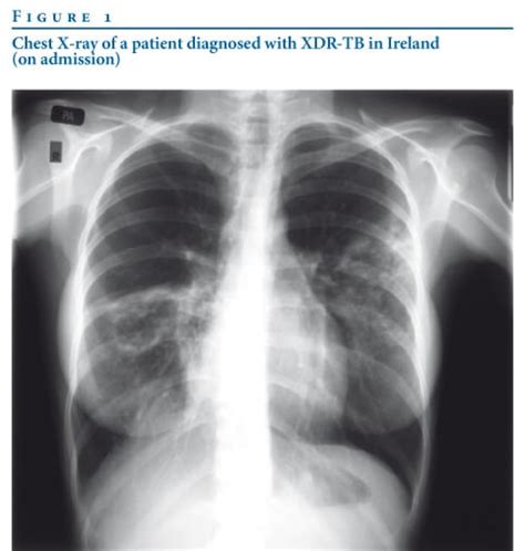 Woman with XDR-TB tuberculosis may have infected hundreds. How did she pass customs?