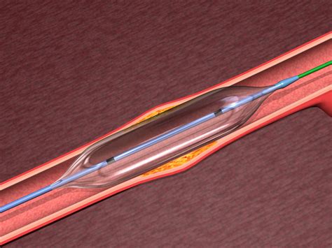 CTEPH Patients May Benefit from Balloon Pulmonary Angioplasty