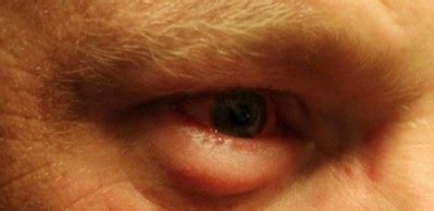 Swollen Eyelids - Causes, Pictures and Treatment