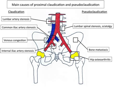 Frontiers | Internal Iliac Artery Stenosis: Diagnosis and How to Manage it in 2015 ...
