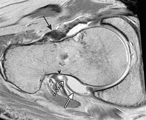 Iliofemoral Ligament Mri