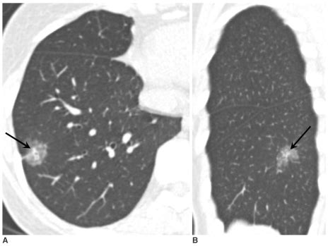 Mixed nodular ground-glass opacity in the right lower lobe confirmed as... | Download Scientific ...