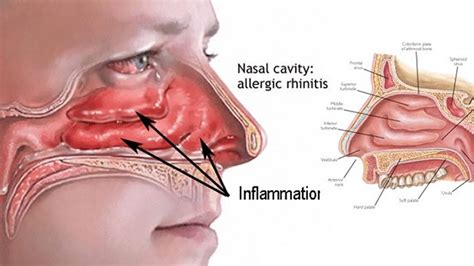 The best natural remedies for nasal congestion