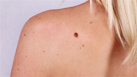 Majority Of Melanoma Skin Cancer Patients 'Do Not Have Irregular Moles', Study Suggests ...