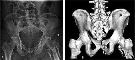 Lumbo-sacral Junction Instability by Traumatic Sacral Fractures: Isler ...